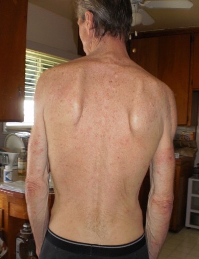 Skinrash2014jan